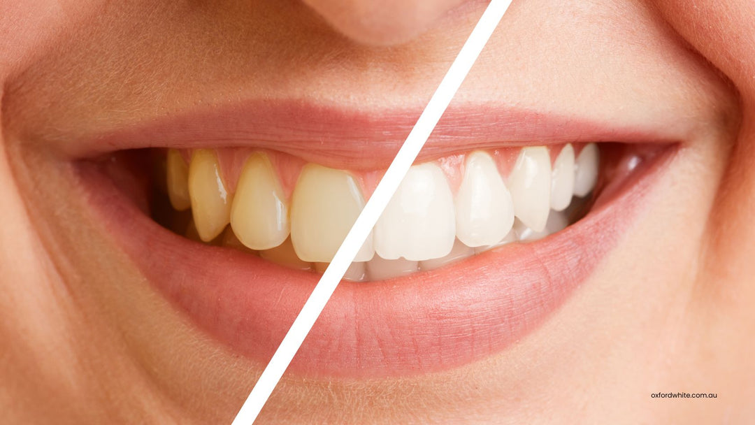 How Long Do Teeth Whitening Results Last?